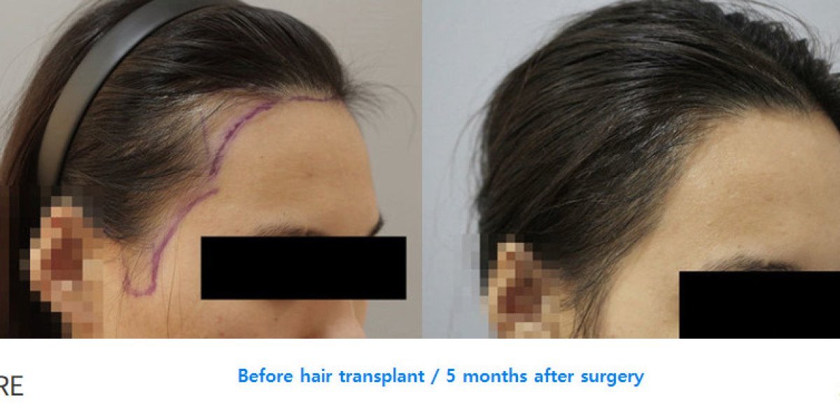 Transform Your Look with Before and After Hair Transplant Results
