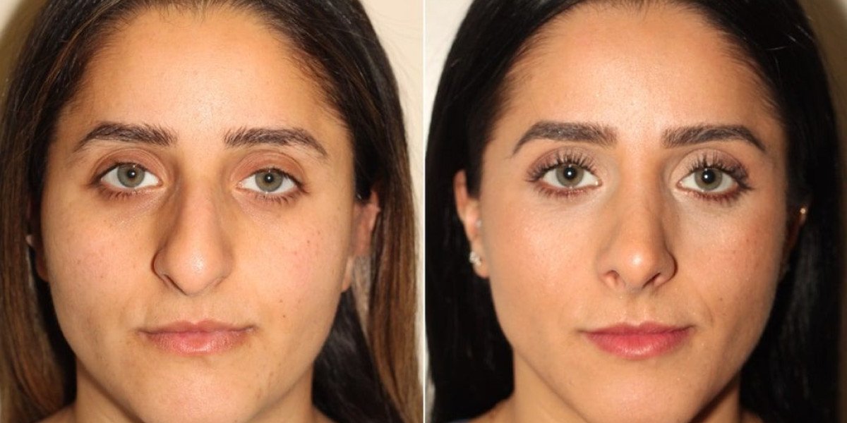 Rhinoplasty in Islamabad: Myths, Risks, Costs, and Modern Surgical Standards